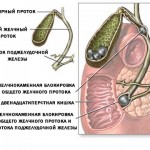 Желчнокаменная болезнь - камни в желчном пузыре и желчных протоках